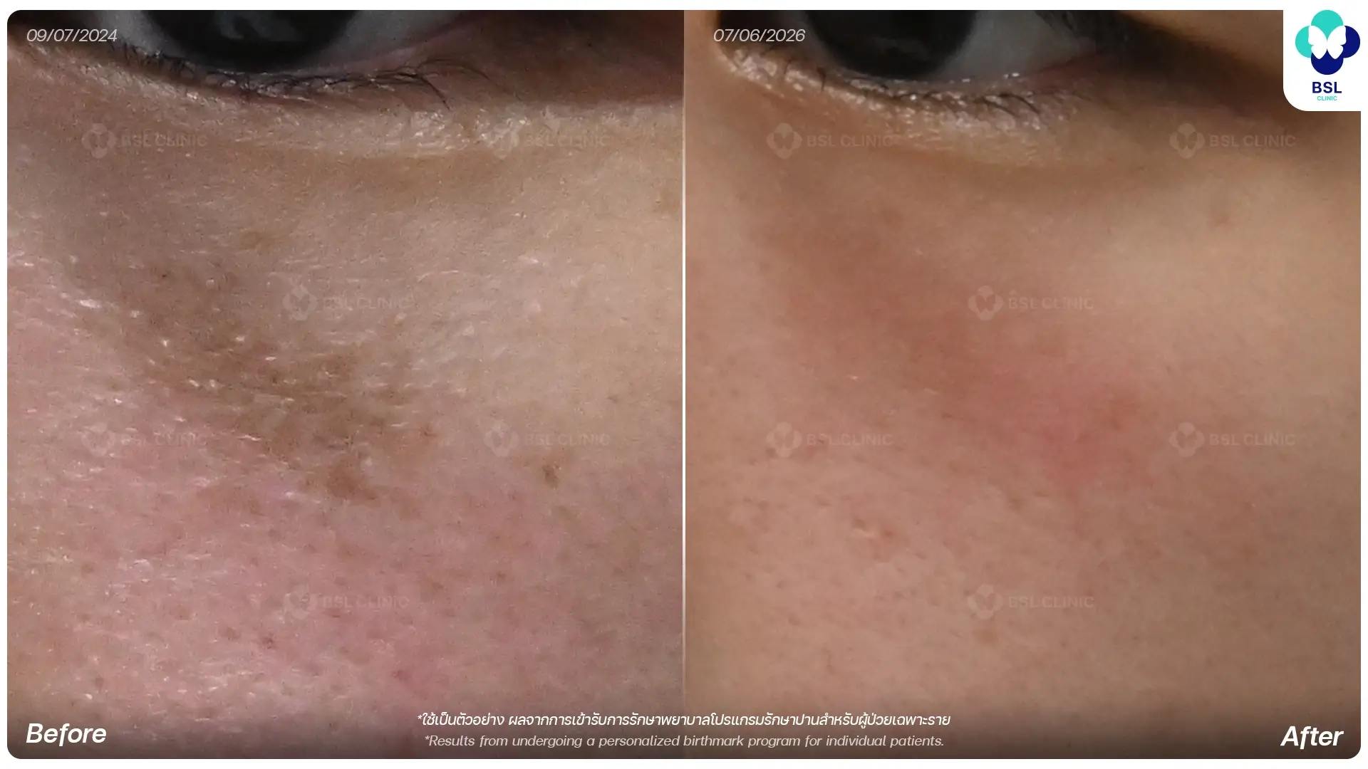 รักษาปาน Birthmark Treatment