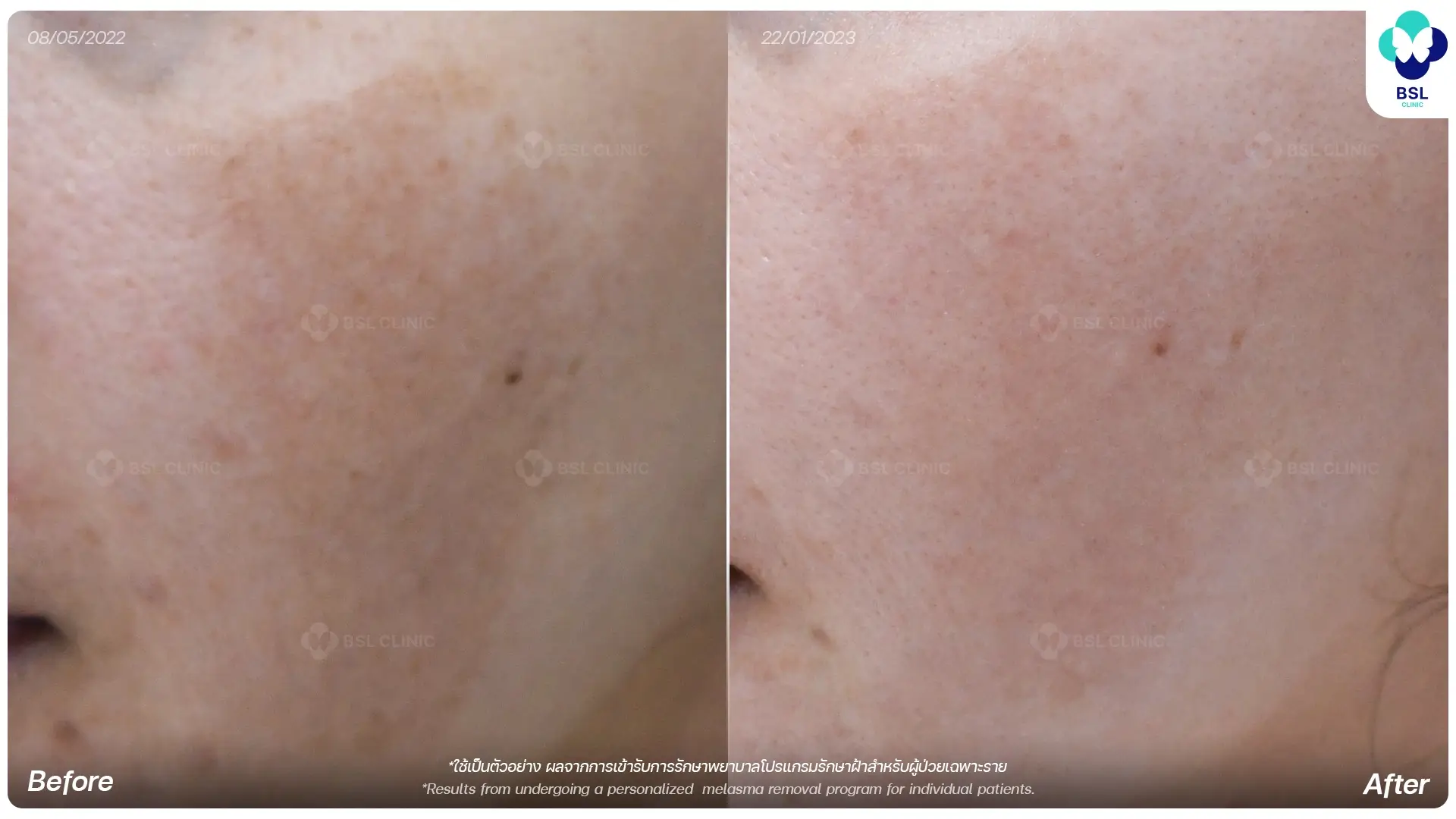 รักษาฝ้ากระ melasma freckles treatment