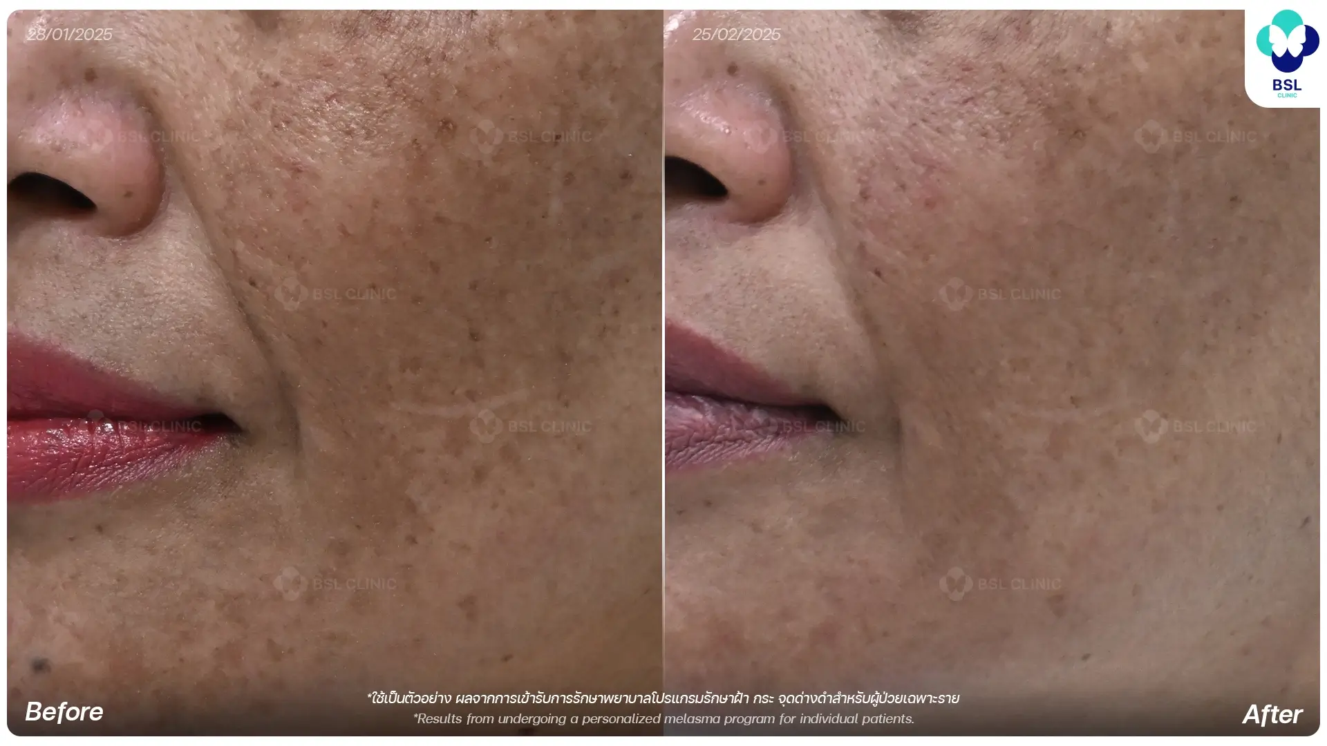 รักษาฝ้าผสมผสาน Melasma Combined Treatment