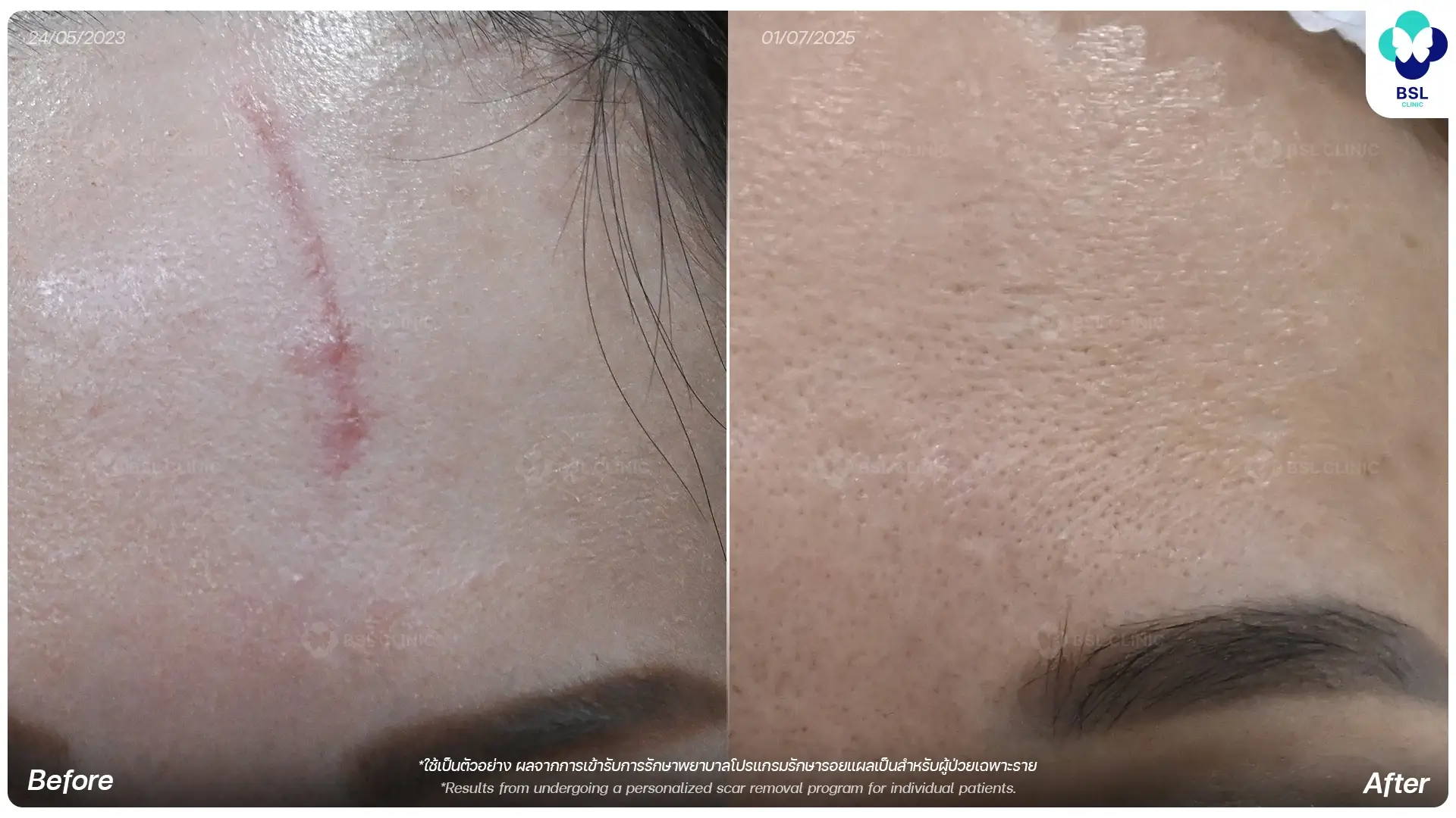 รักษารอยแผลเป็น scar removal treatment