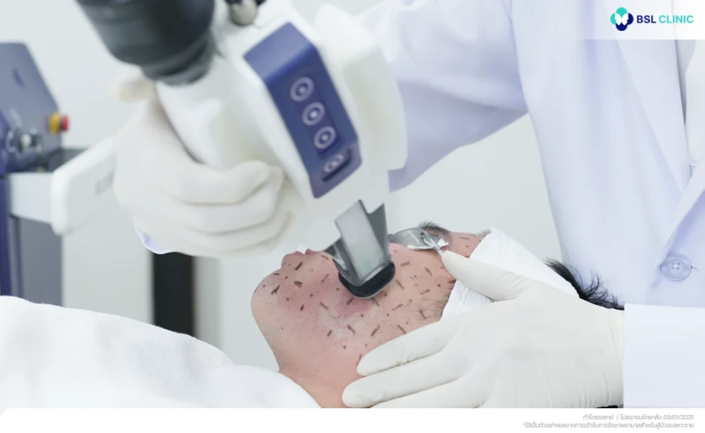 Accure Laser Program