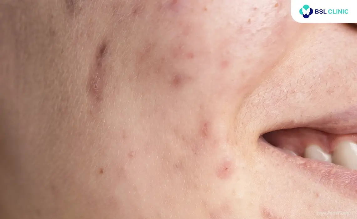 รักษาหลุมสิว PicoWay Acne Scar
