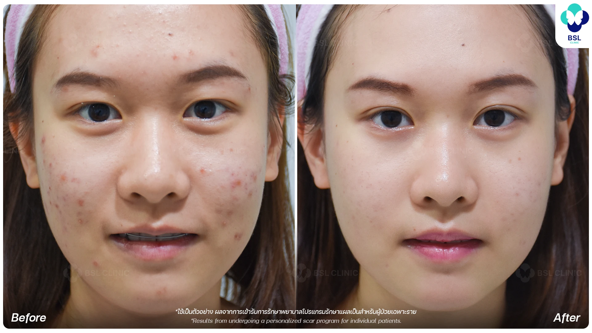ตัวอย่างผลการรักษาสิวที่ BSL Clinic