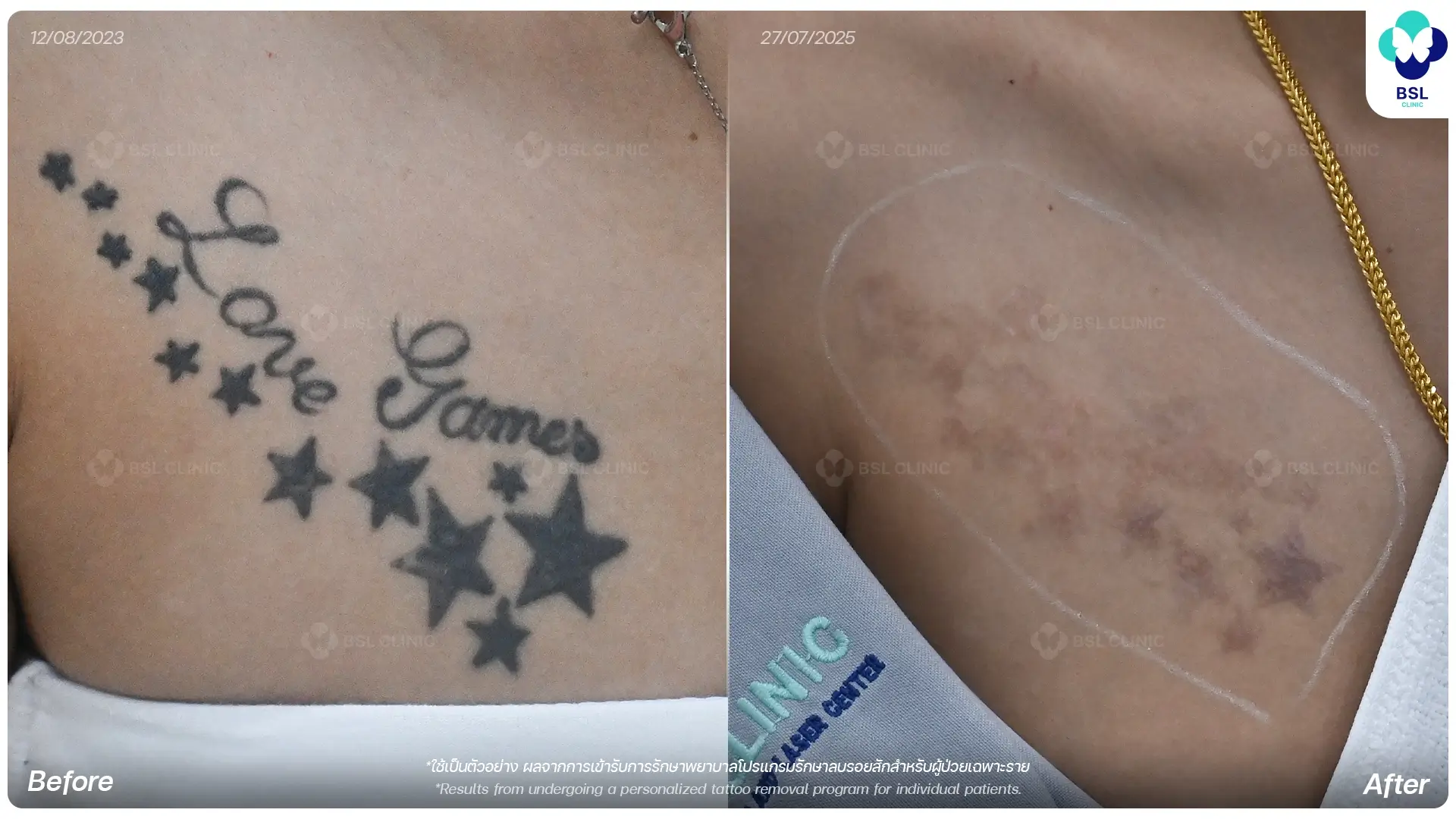 ลบรอยสัก tattoo removal laser treatment