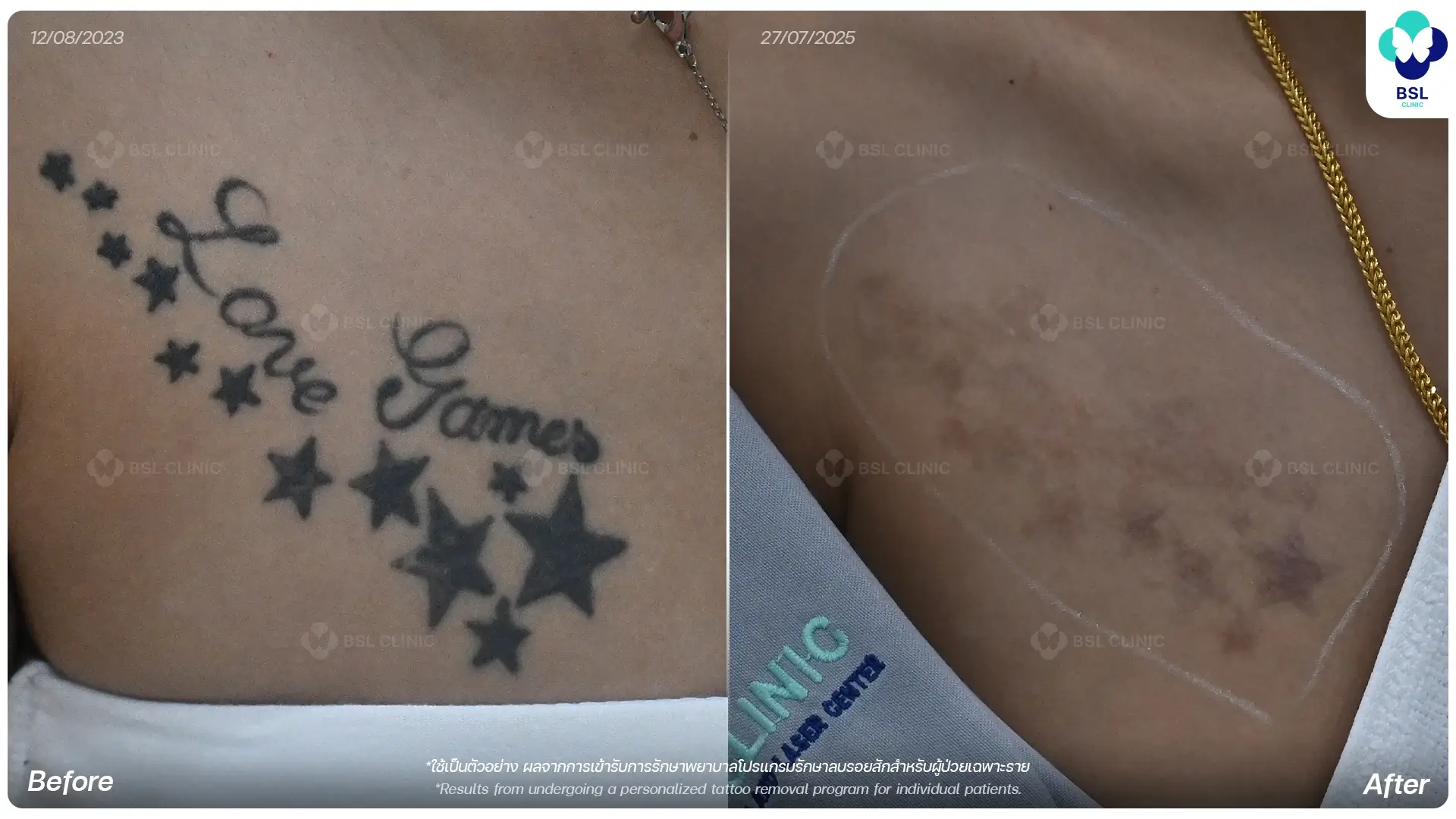 ลบรอยสัก tattoo removal laser treatment