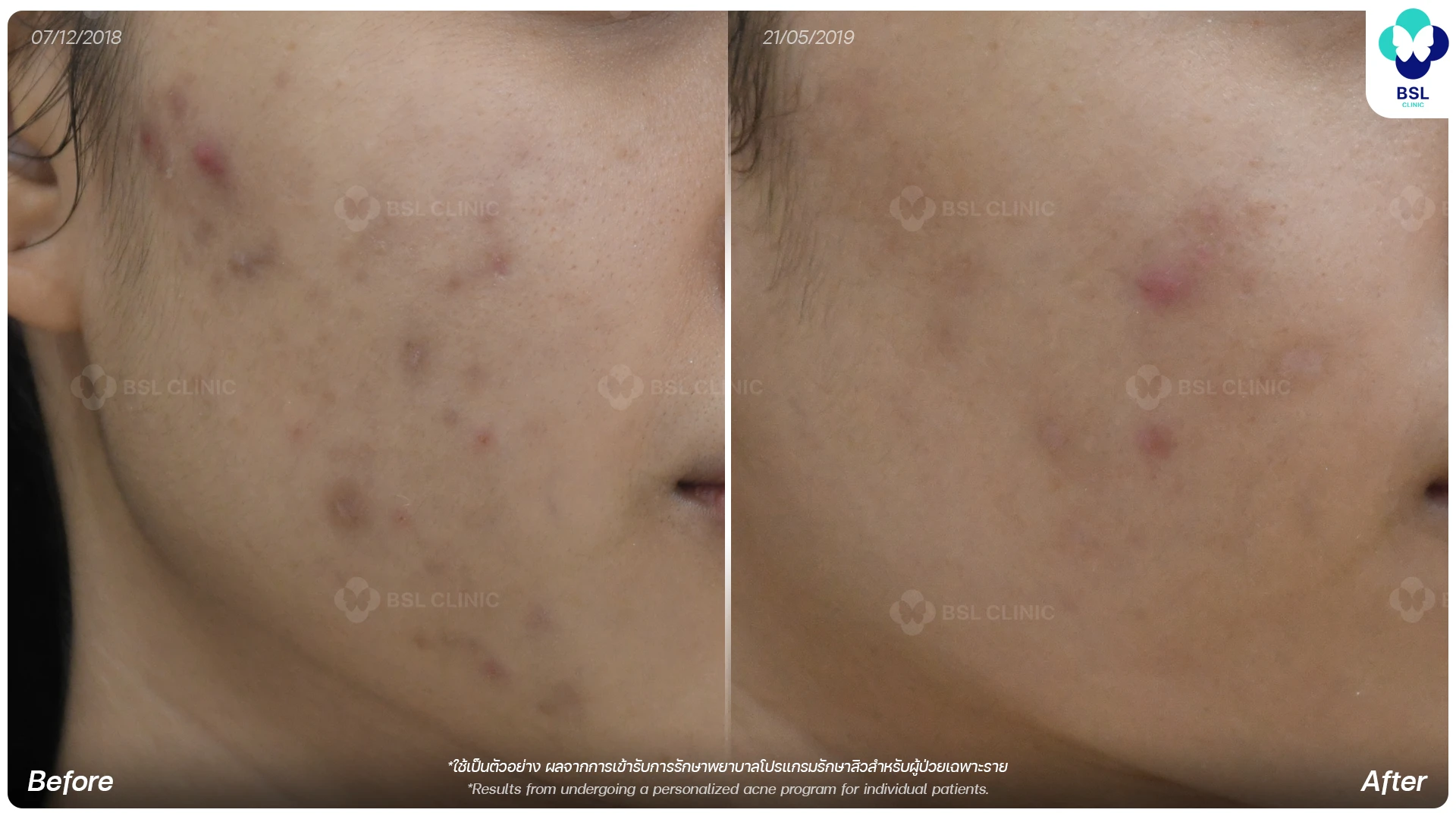 สิว_รอยดำ_611141-L_ณัฐณิชา-พูนผล_02