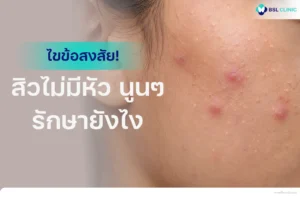 สิวไม่มีหัว-นูนๆ