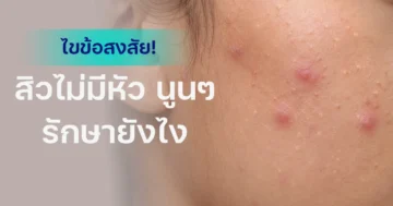 สิวไม่มีหัว-นูนๆ