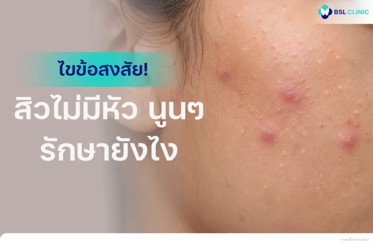 สิวไม่มีหัว-นูนๆ