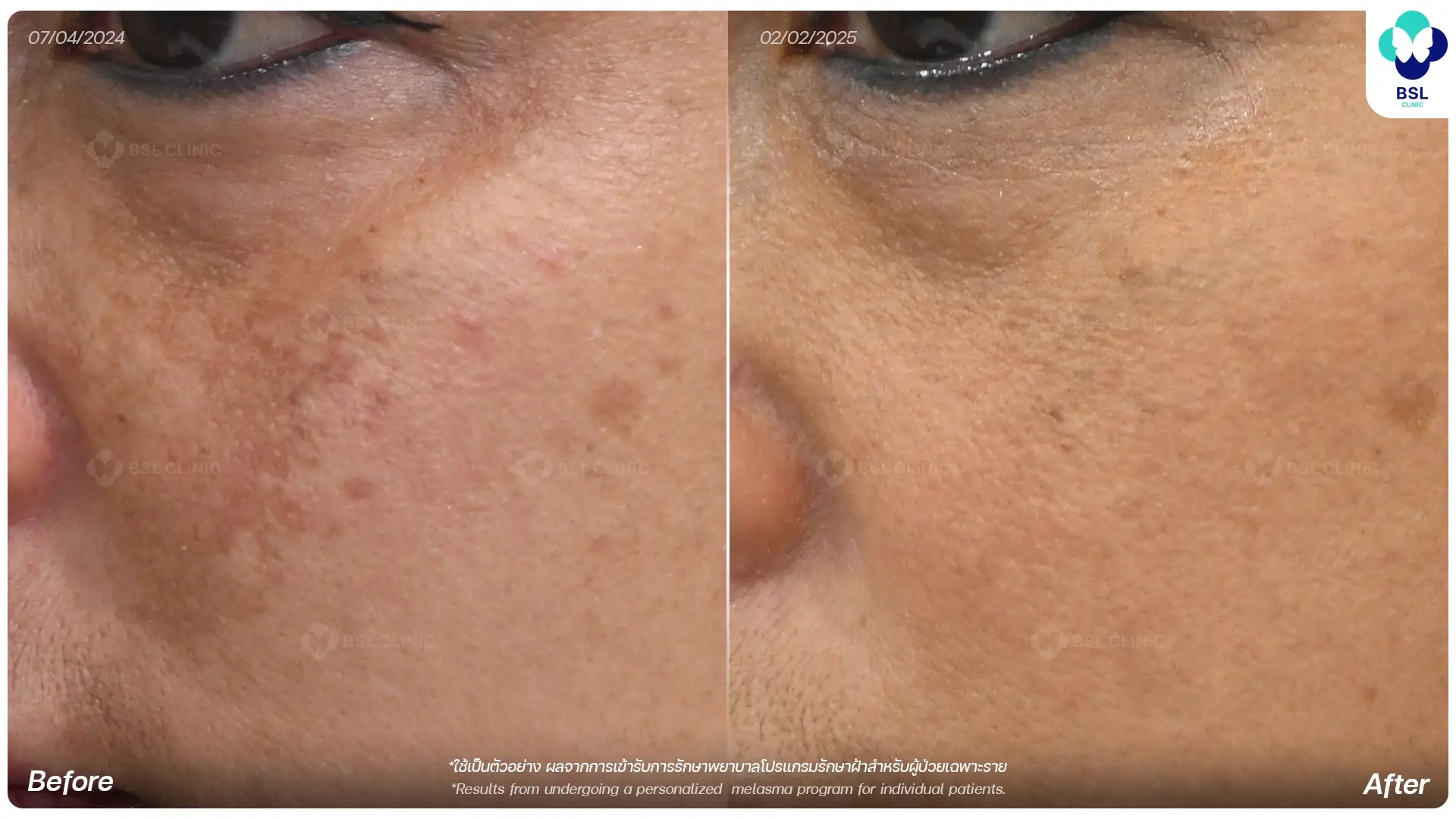 เลเซอร์ฝ้าฮอร์โมน Hormonal Melasma Laser