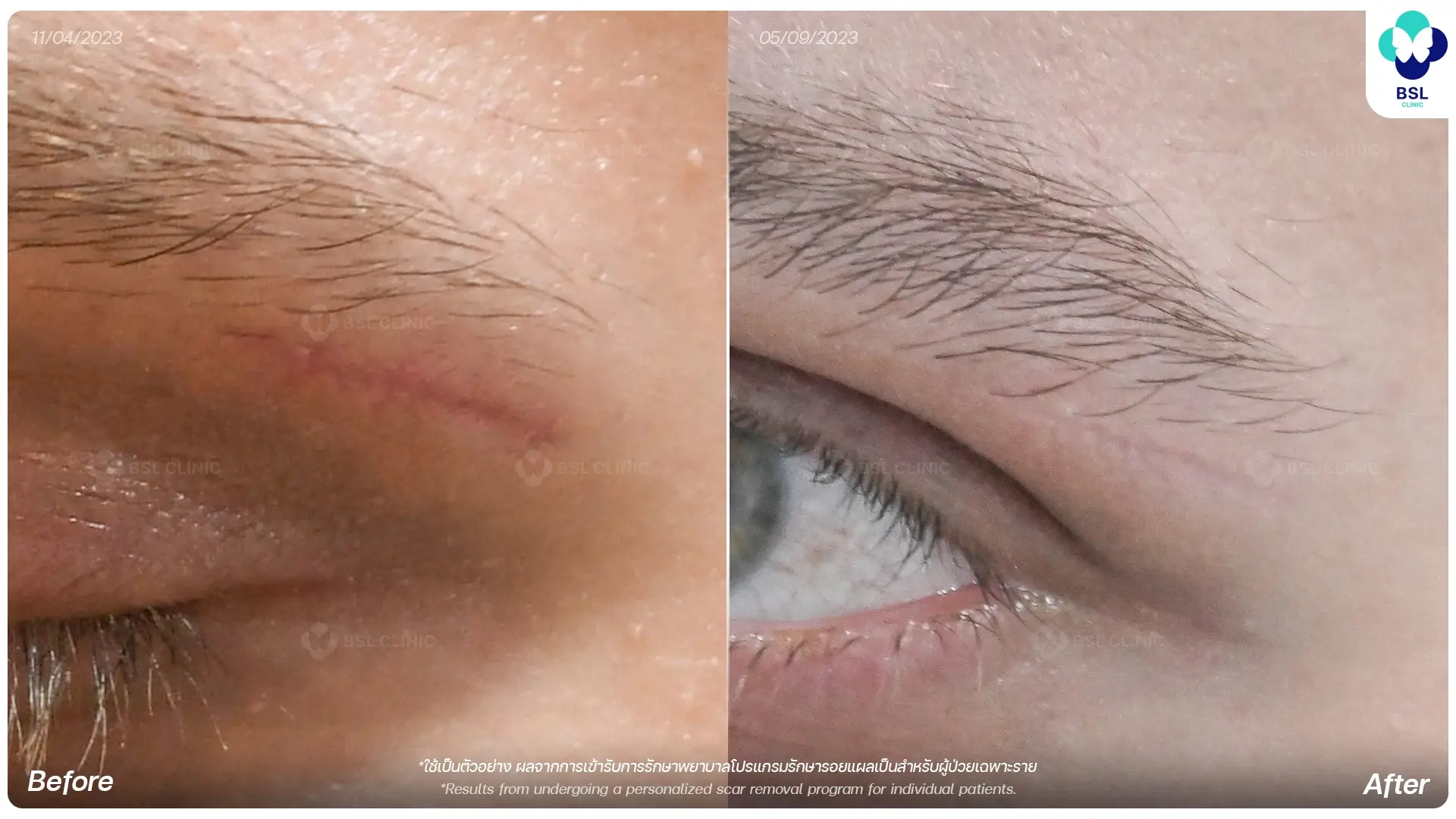 เลเซอร์รอยแผลเป็น scar removal laser