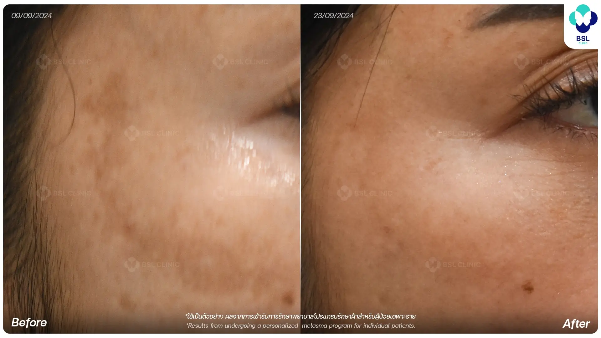 เลเซอร์รักษาฝ้า Melasma PicoWay Laser