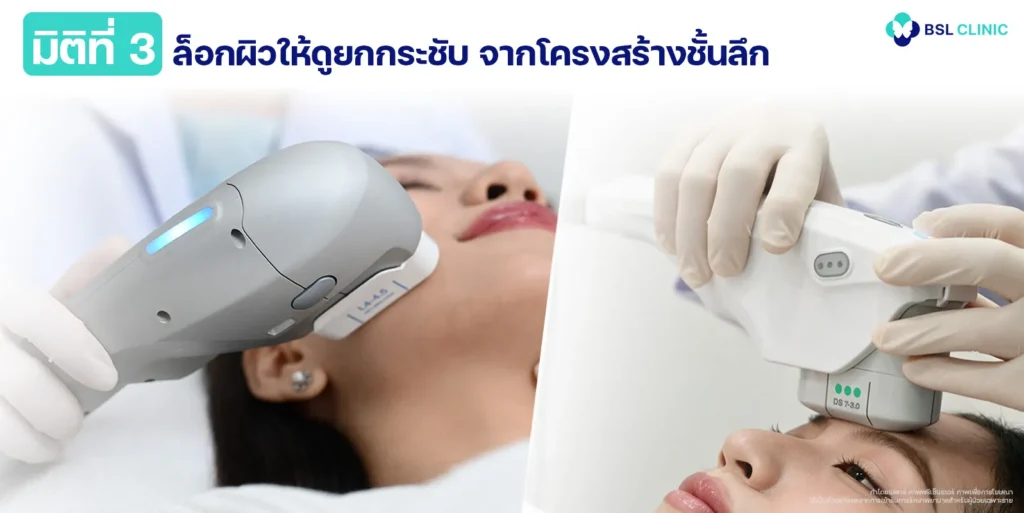 มิติที่ 3 ชั้น SMAS ยกกระชับจากโครงสร้างชั้นลึก
