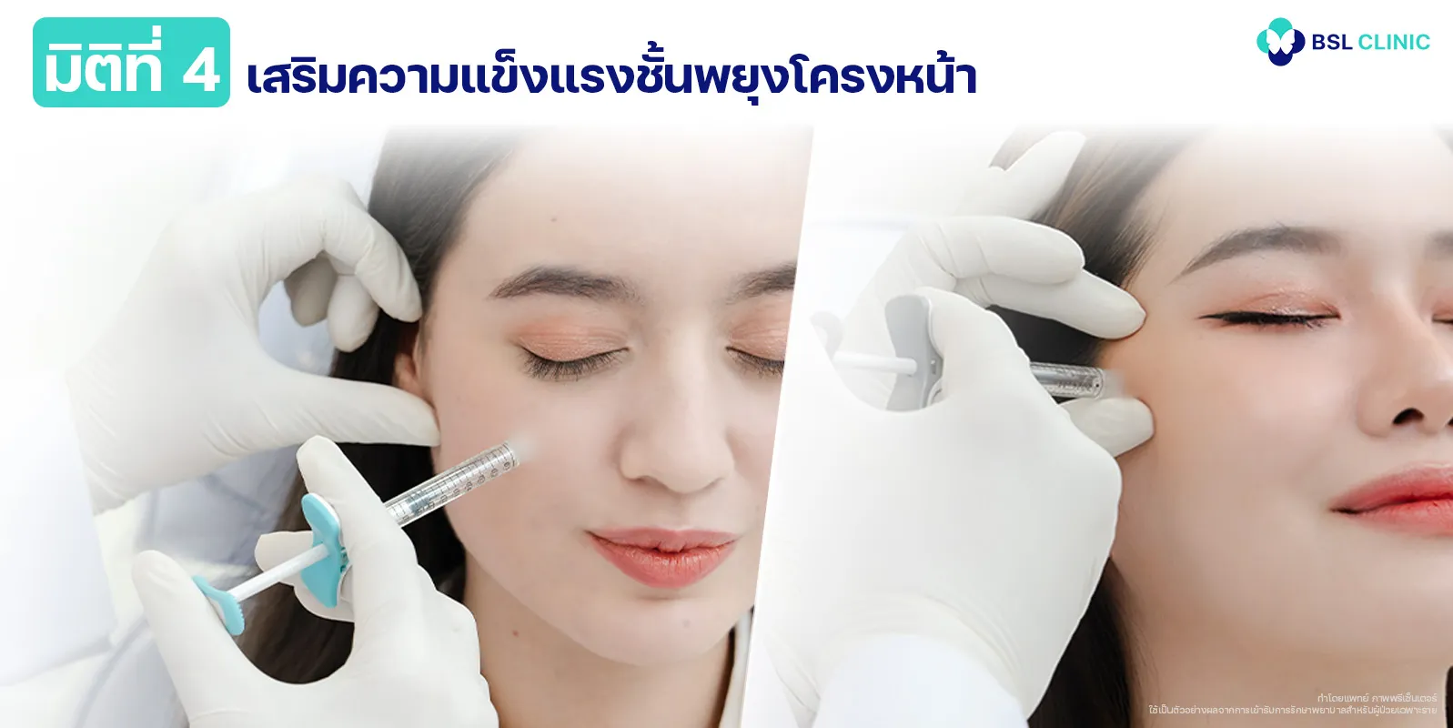 มิติที่ 4 เส้นเอ็น เสริมความแข็งแรงชั้นพยุงโครงหน้า