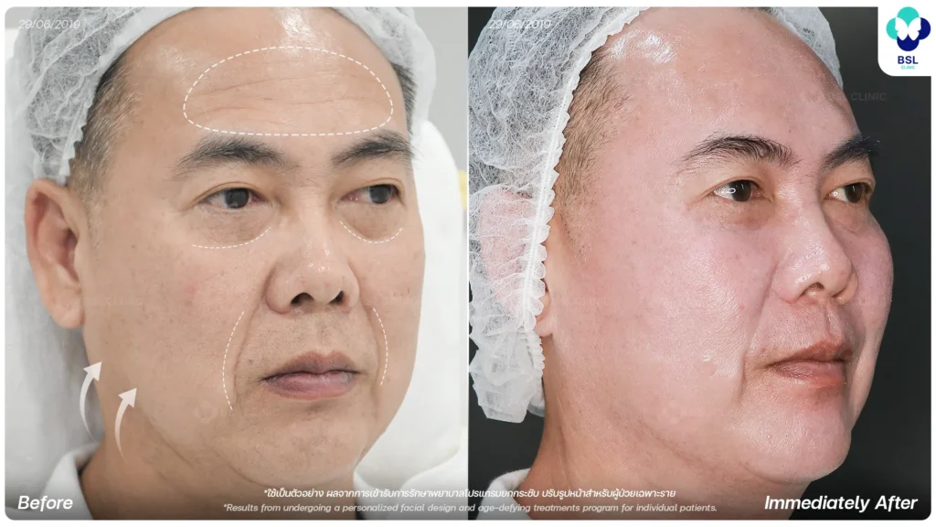 ภาพก่อน - หลังการยกกระชับ 1