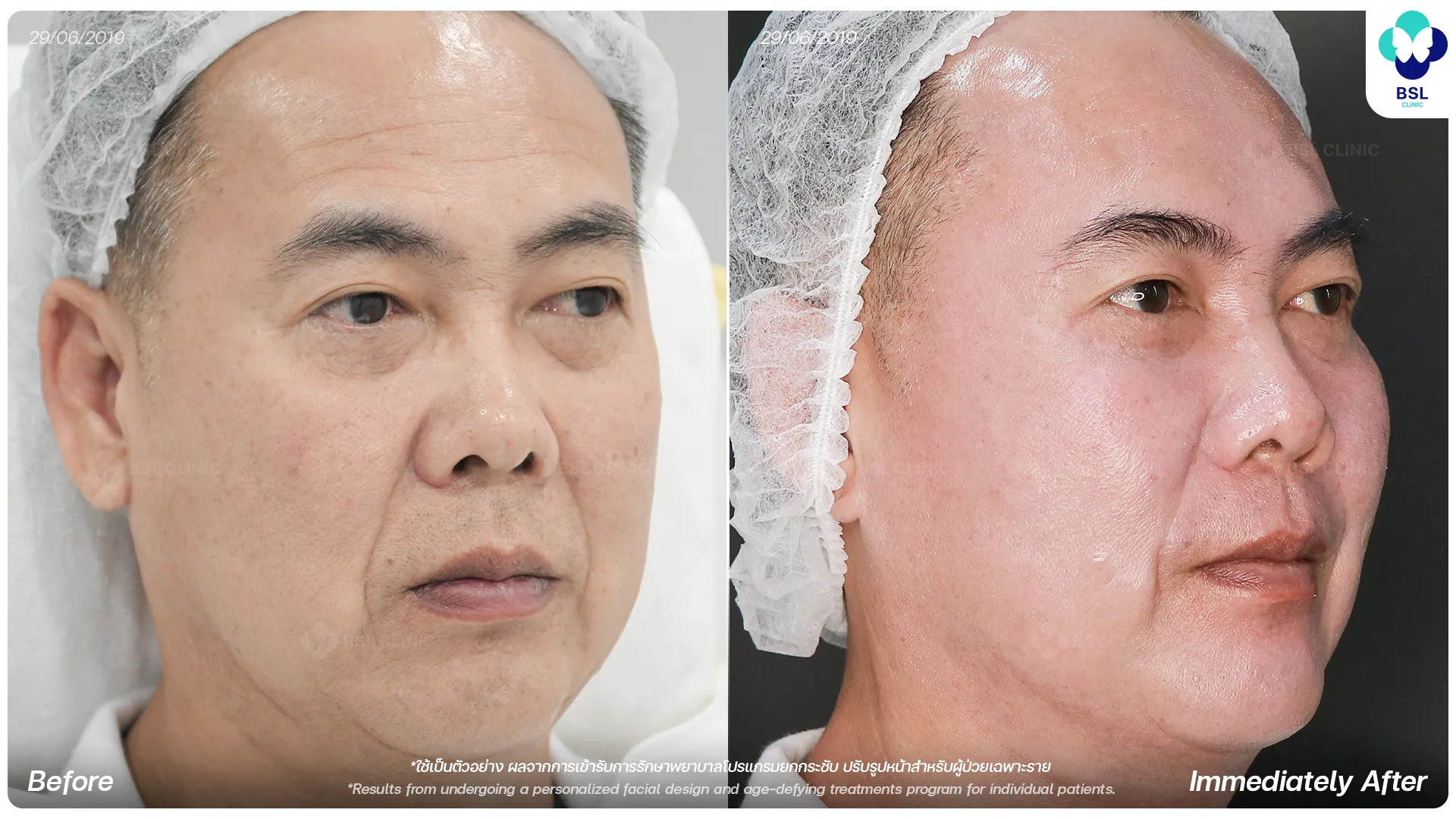 แก้ผิวหย่อนคล้อย-02