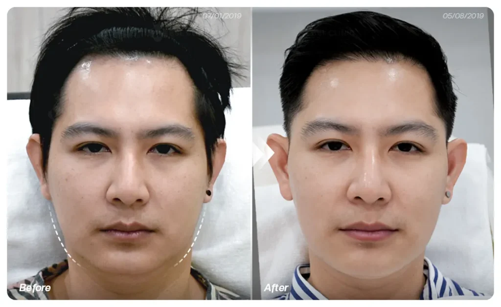 ยกกระชับหน้า