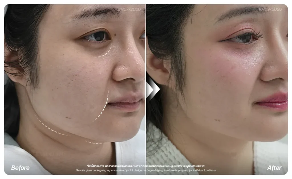 ยกกระชับหน้า