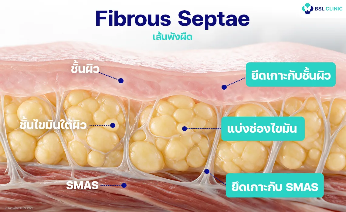 Fibrous Septae (เส้นพังผืด)
