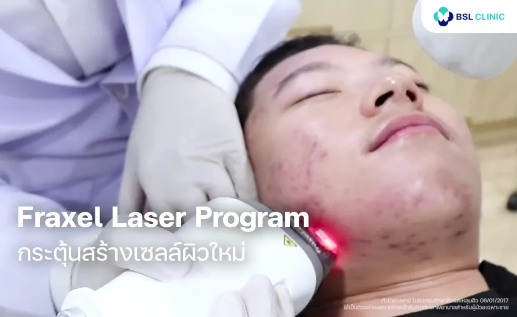 Fraxel Laser Program โปรแกรมกระตุ้นการฟื้นฟูผิวและดูแลปัญหาหลุมสิว