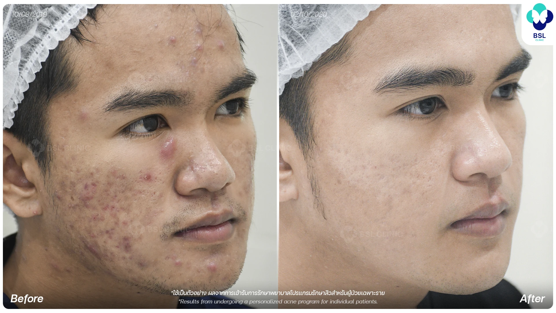 ตัวอย่างผลการรักษาสิวที่ BSL Clinic