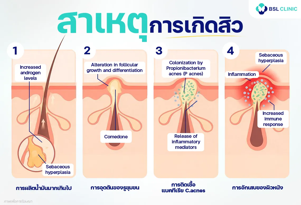 สาเหตุการเกิดสิว