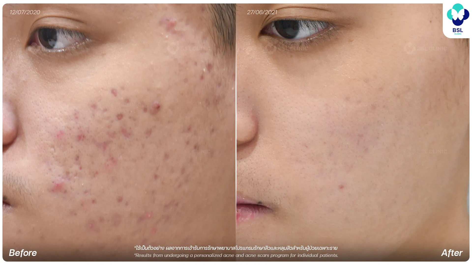 รีวิวรักษาสิวและหลุมสิว