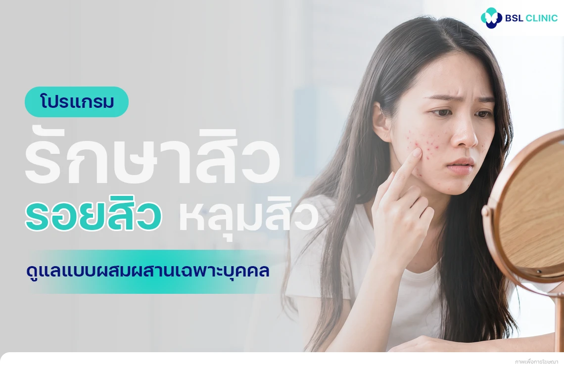 acne-treatment รักษาสิว