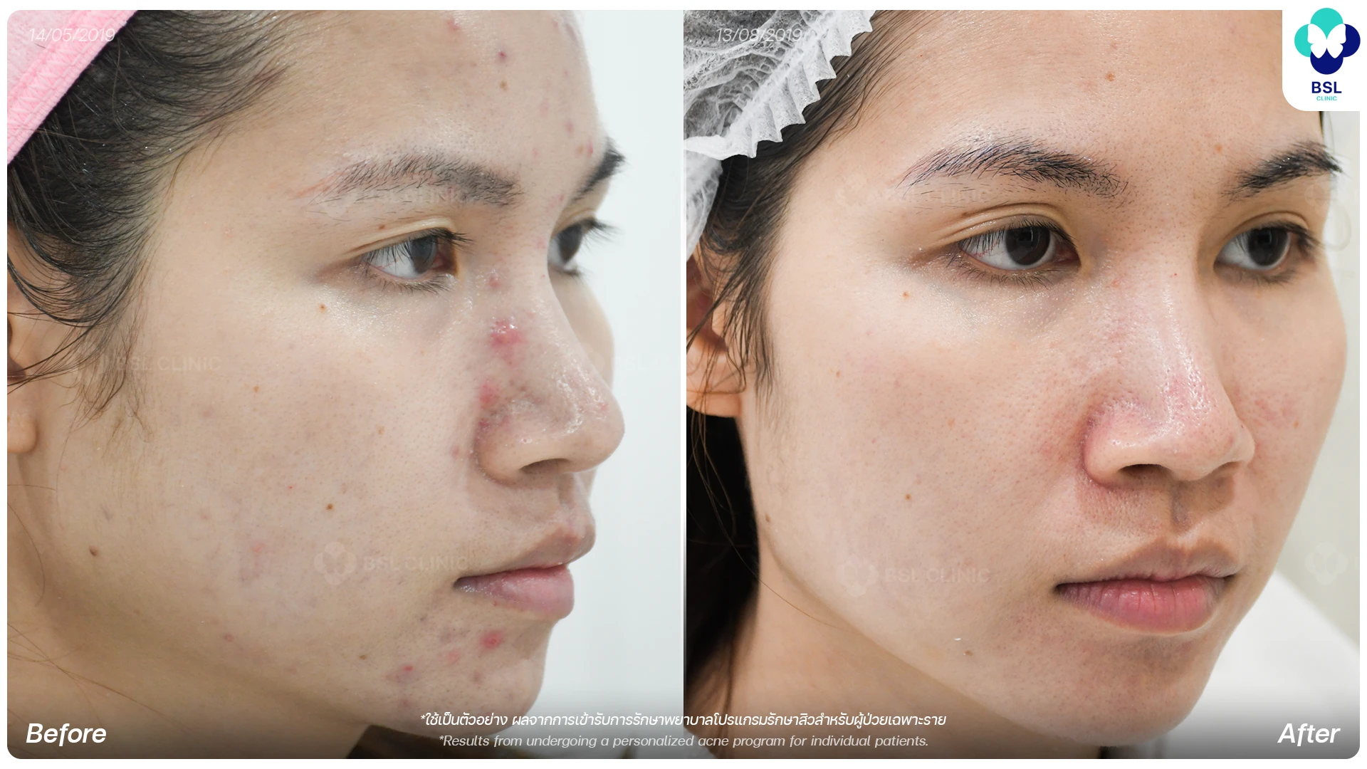 ตัวอย่างผลการรักษาสิวที่ BSL Clinic