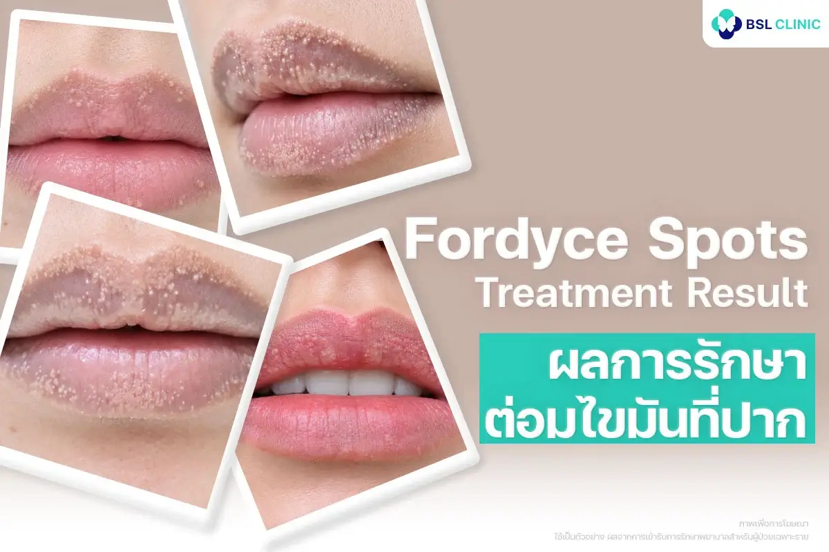 Fordyce Spots Treatment Result ผลการรักษาต่อมไขมันที่ปาก