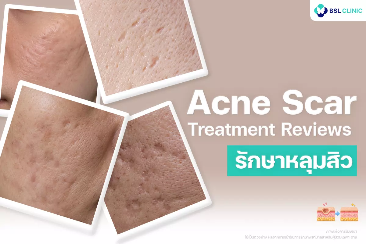 รีวิวรักษาหลุมสิว Acne Scar Treatment Reviews