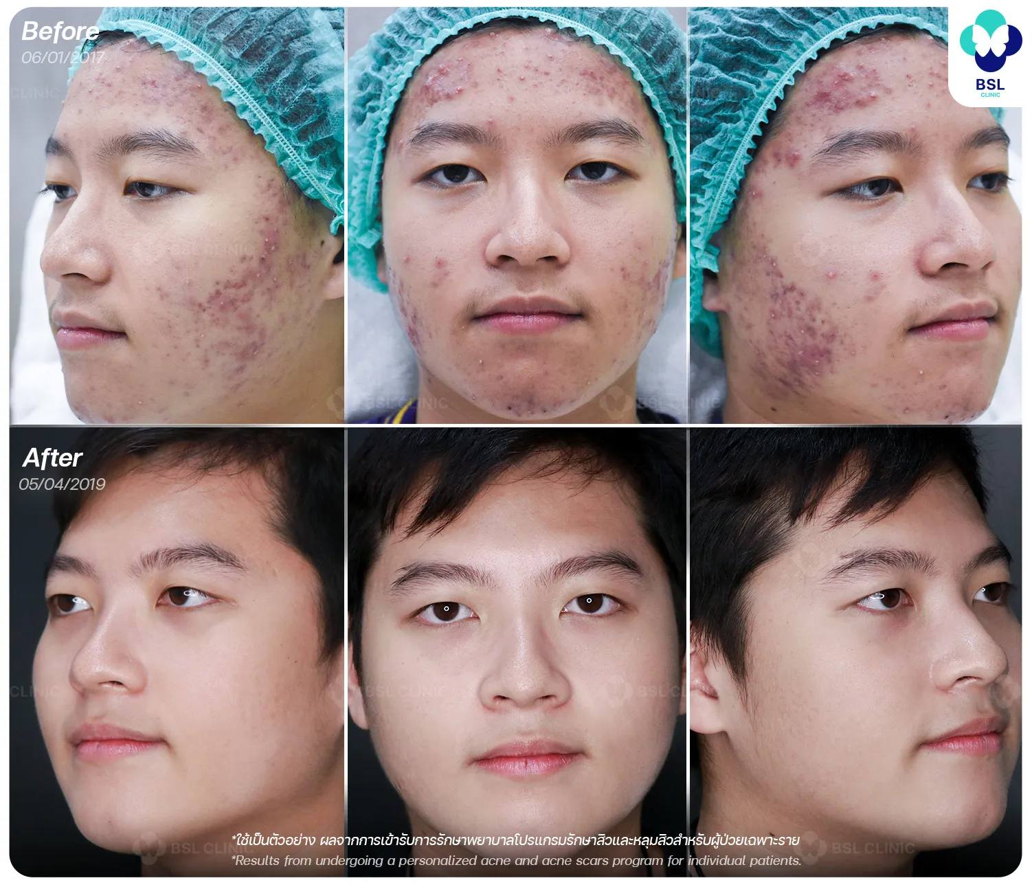 รีวิวรักษาสิวและหลุมสิว