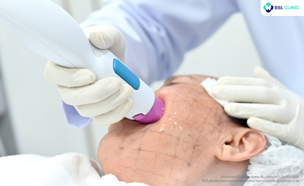 Thermage FLX