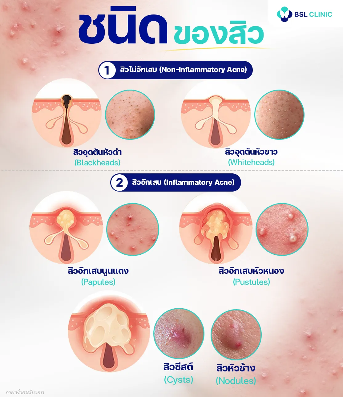 ชนิดของสิว