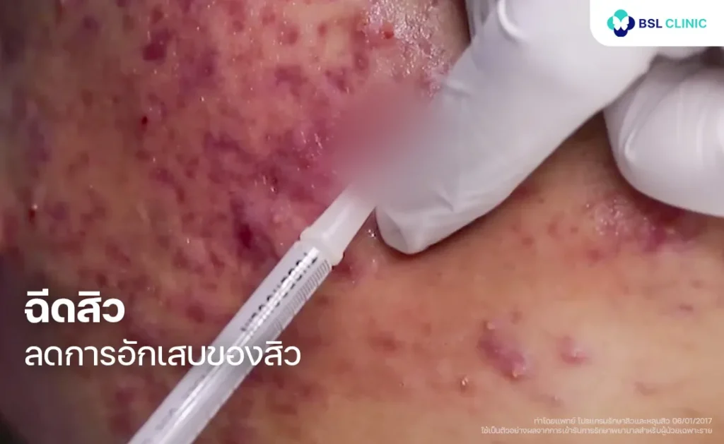 ฉีดสิว เพื่อลดการอักเสบของสิวและทำให้สิวยุบ