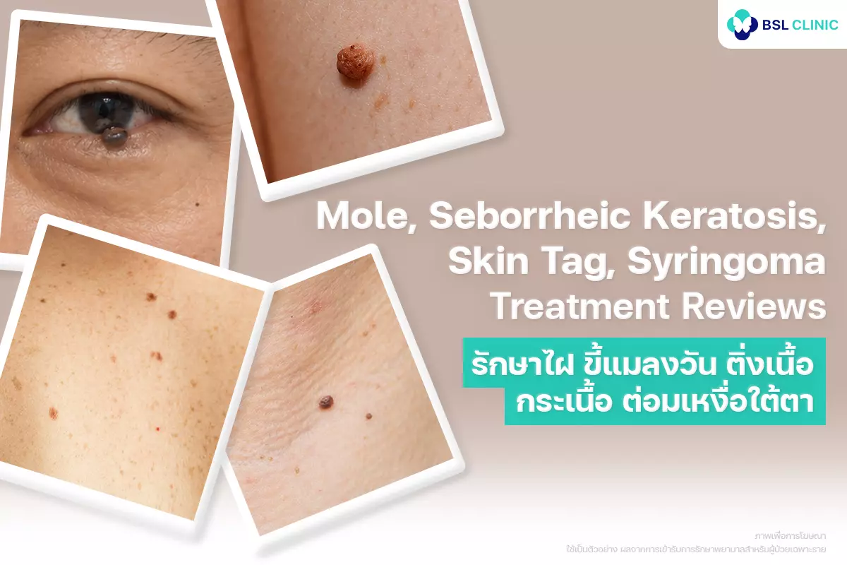 ภาพผลการรักษา-ไฝ-กระเนื้อ-ติ่งเนื้อ-bsl-clinic-ba