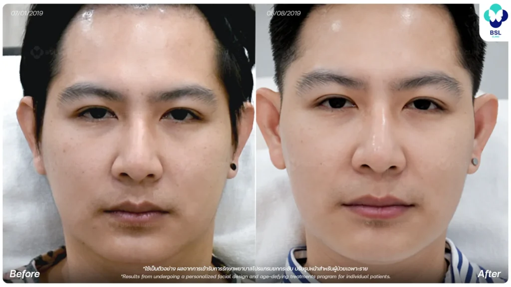 ยกกระชับคุณนันท์นิพัทธ์