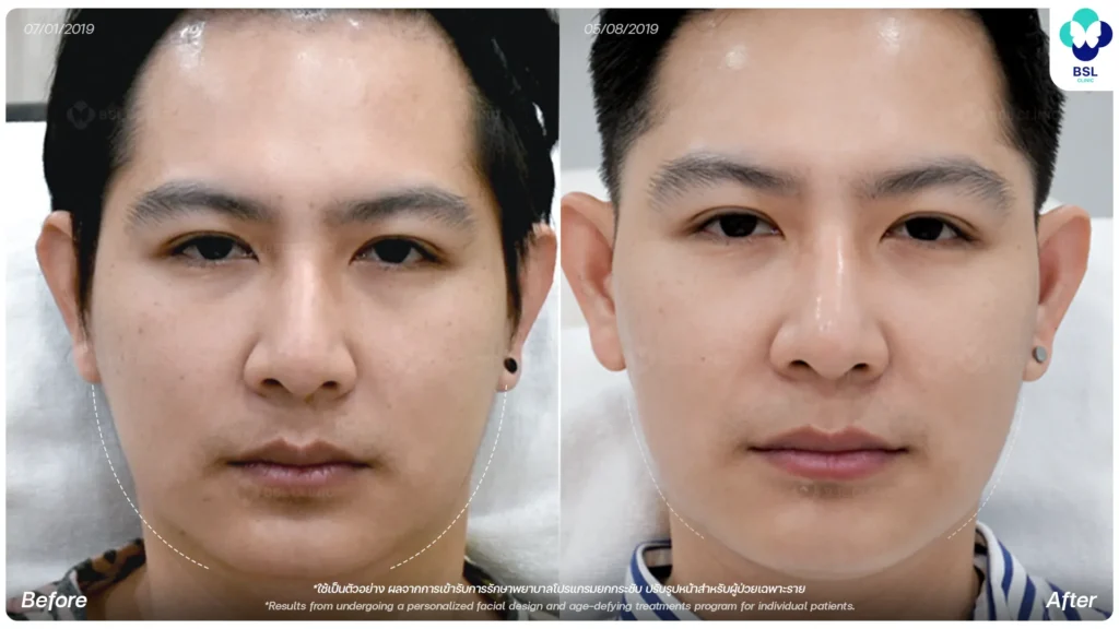 ภาพก่อน - หลังการยกกระชับ 5