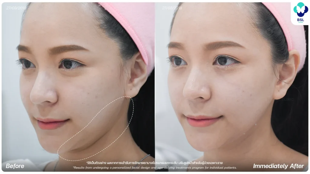 ภาพก่อน - หลังการยกกระชับ 4