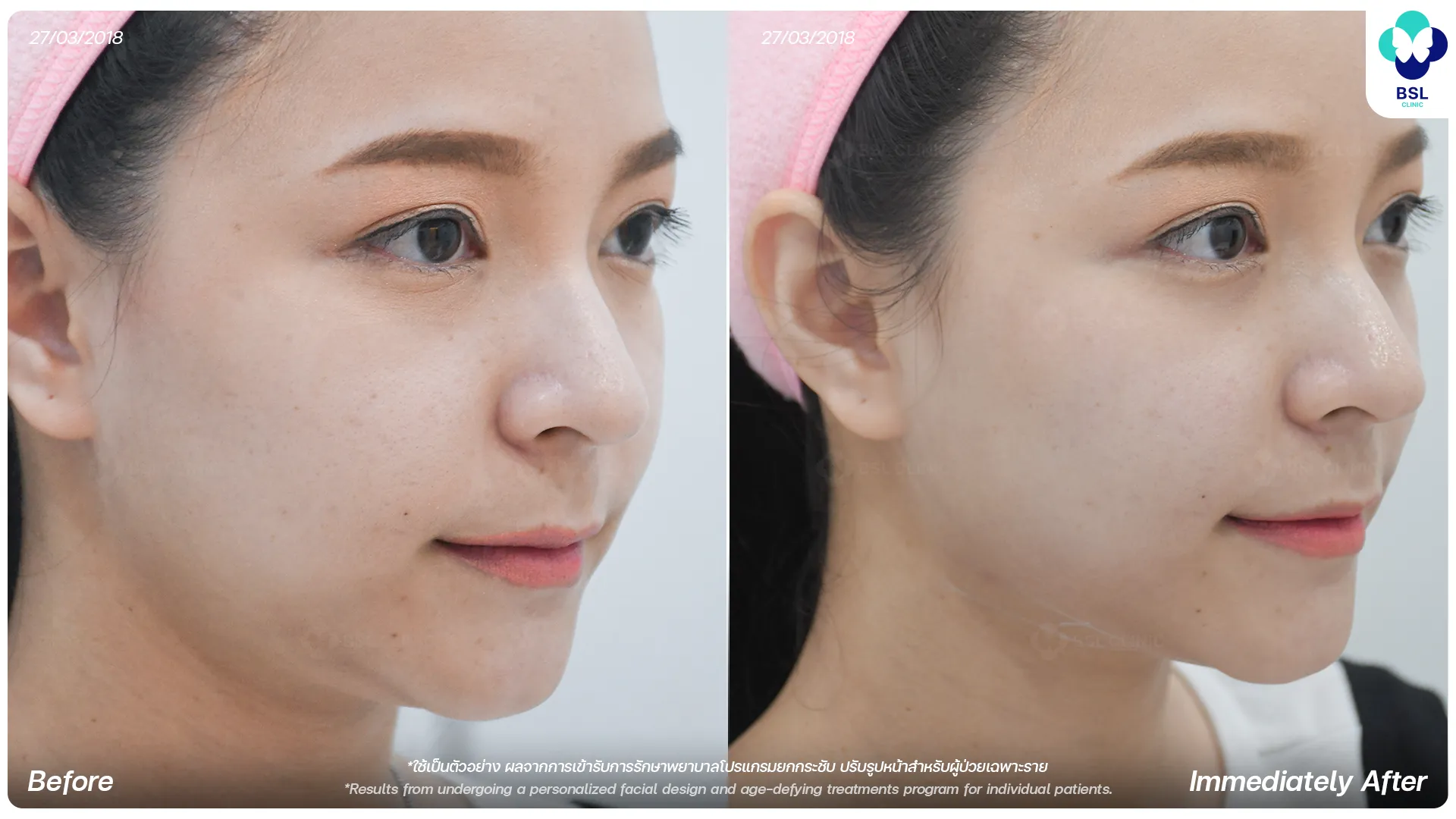 ยกกระชับหน้า-02