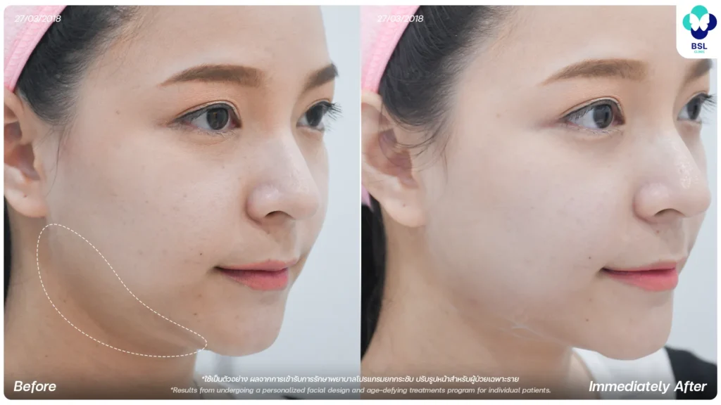 ภาพก่อน - หลังการยกกระชับ 3