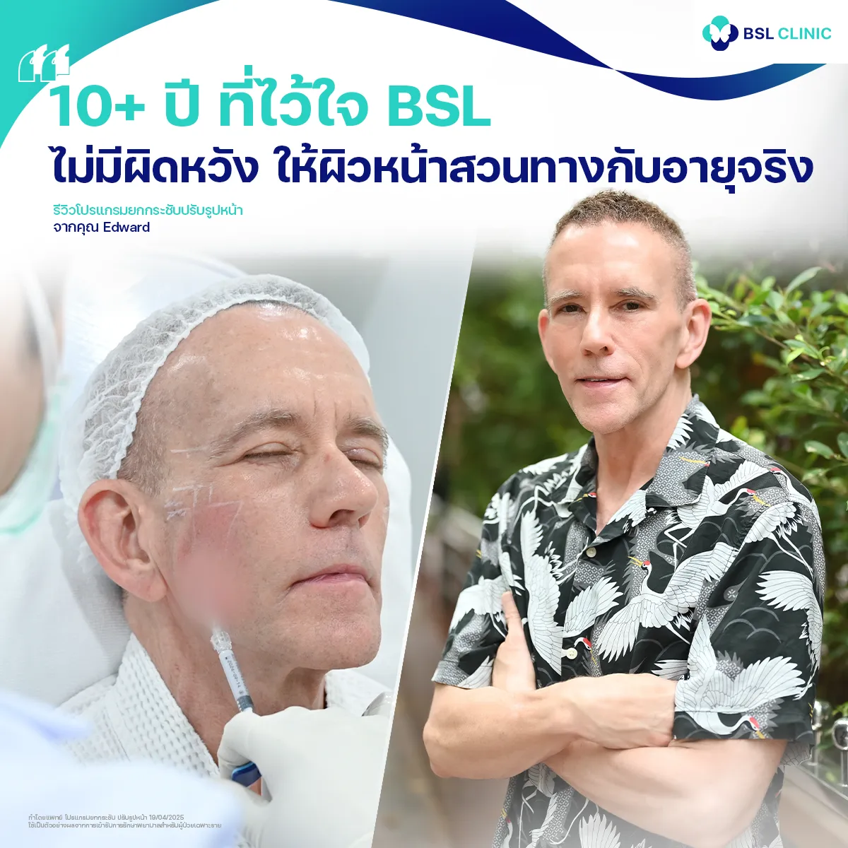 รีวิวหน้ายกกระชับจากผู้ใช้บริการจริง