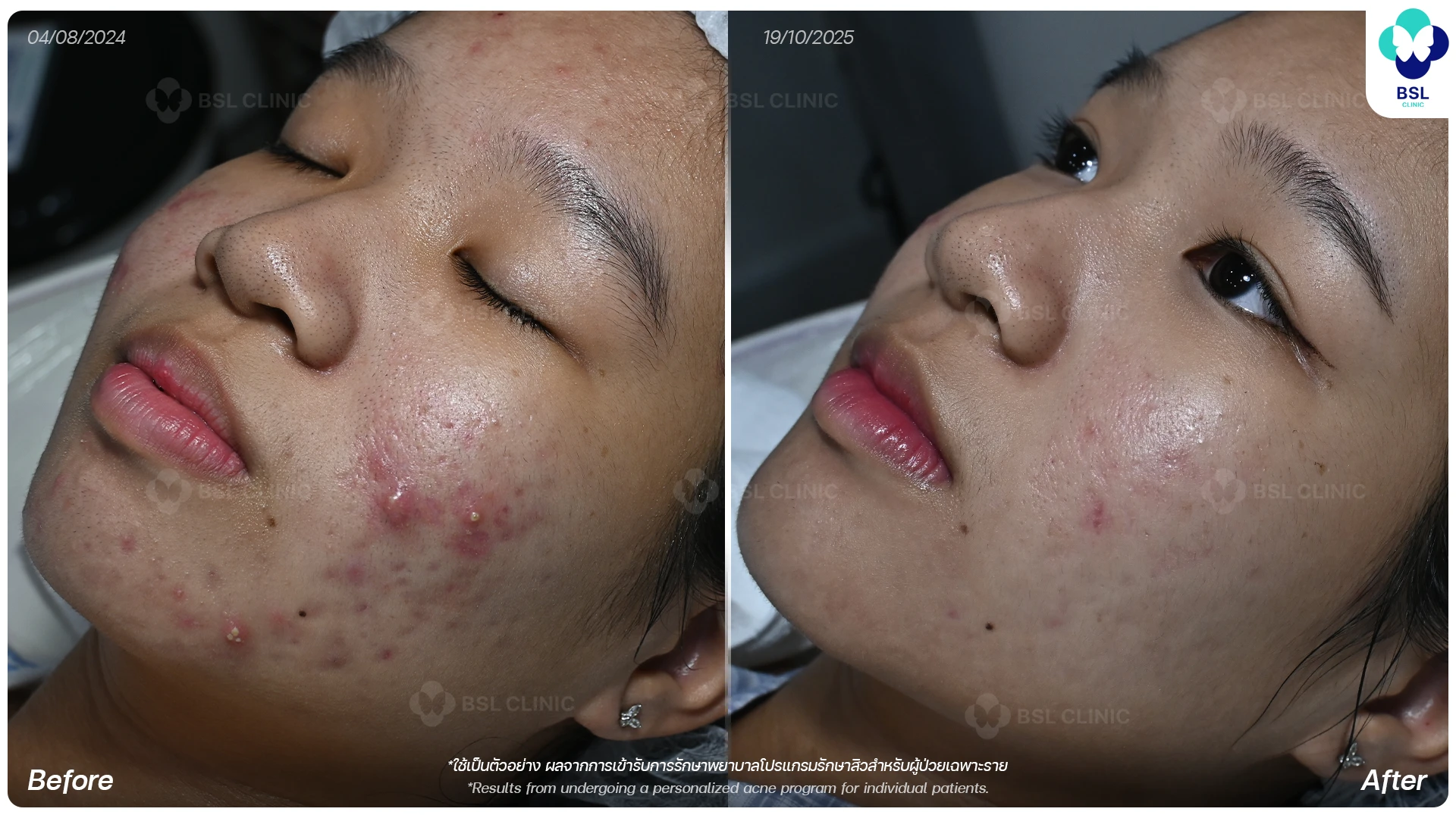 ตัวอย่างผลการรักษาสิวที่ BSL Clinic