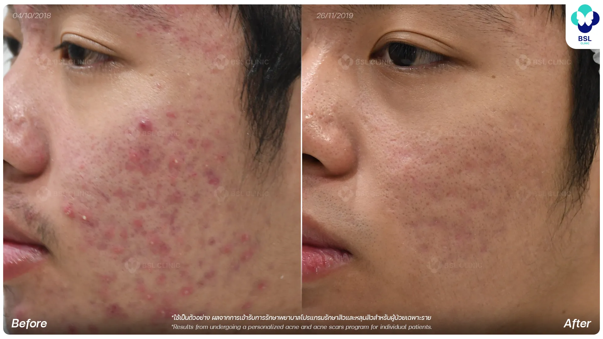 รีวิวรักษาสิว 13 เดือน