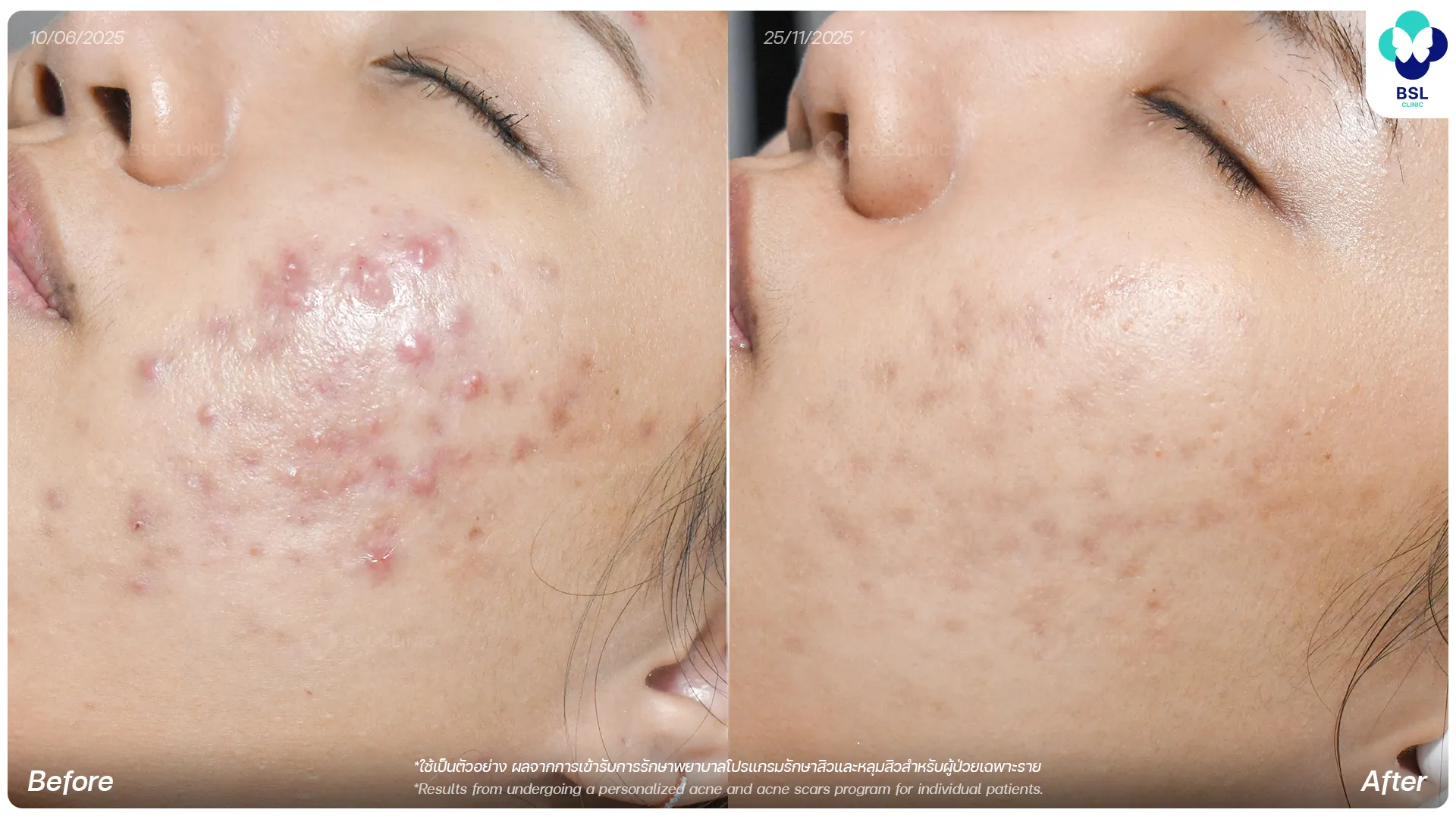 รีวิวรักษาสิวอักเสบ