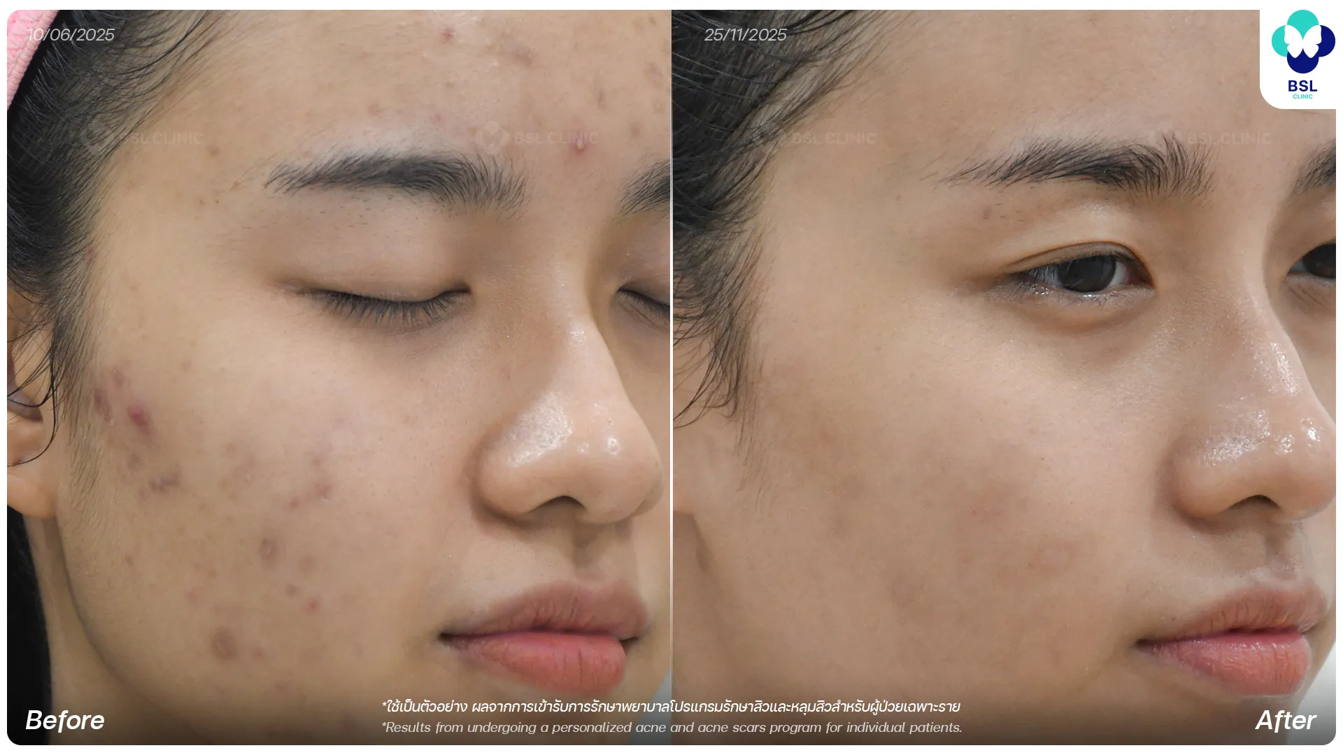 รีวิวรักษาสิวและรอยดำสิว