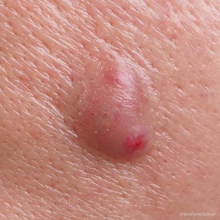 สิวซีสต์ (Cysts)