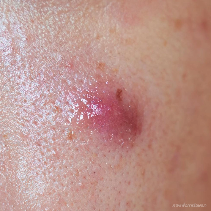 สิวหัวช้าง (Nodules)