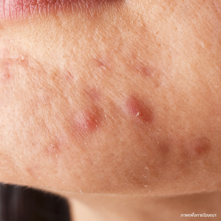 สิวอักเสบนูนแดง (Papules)