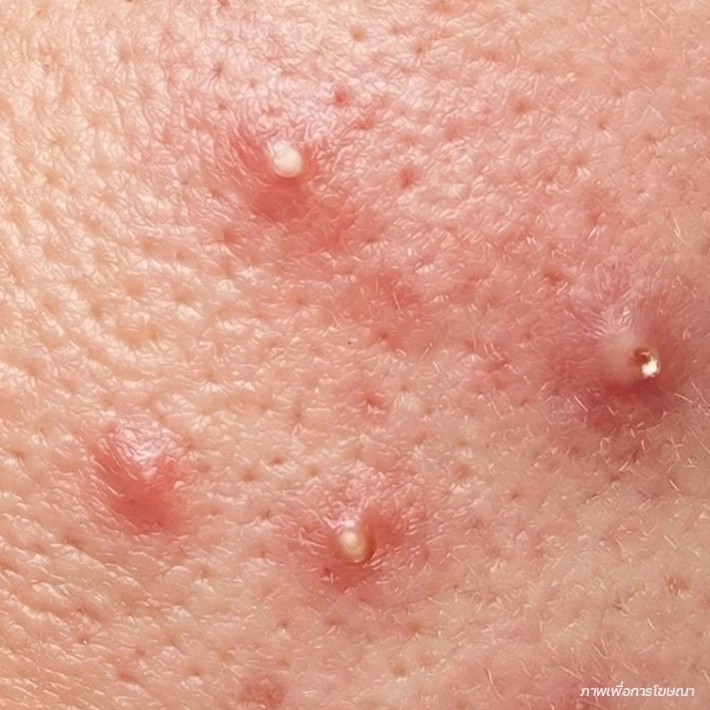 สิวอักเสบหัวหนอง (Pustules)